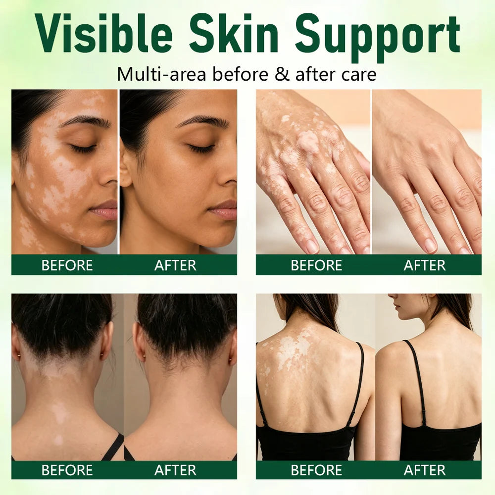 Herbal Vitiligo Cream